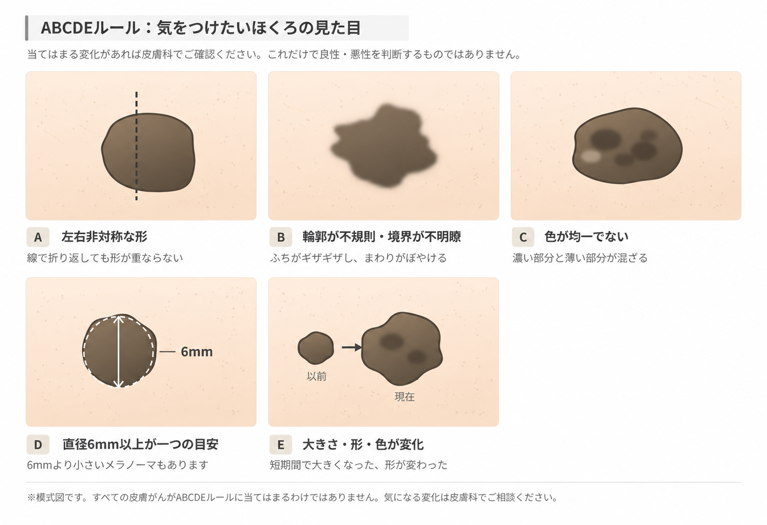 ABCDEルール：左右非対称・不規則な境界・色むら・直径・変化を説明する模式図