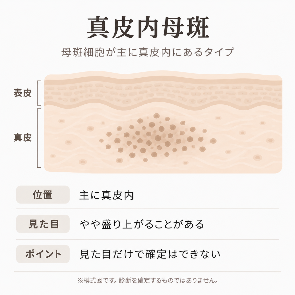 真皮内母斑の母斑細胞の位置を示す皮膚断面イラスト