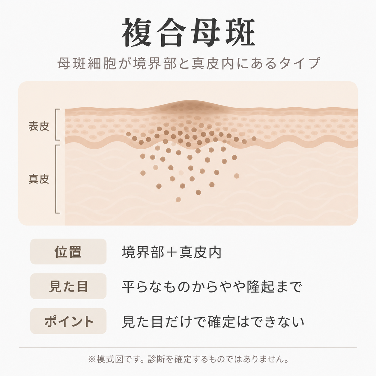 複合母斑の母斑細胞の位置を示す皮膚断面イラスト