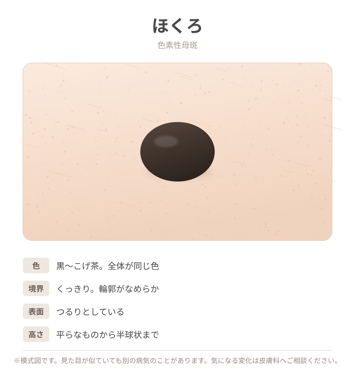 ほくろ（色素性母斑）の見た目と特徴を示した説明用イラスト