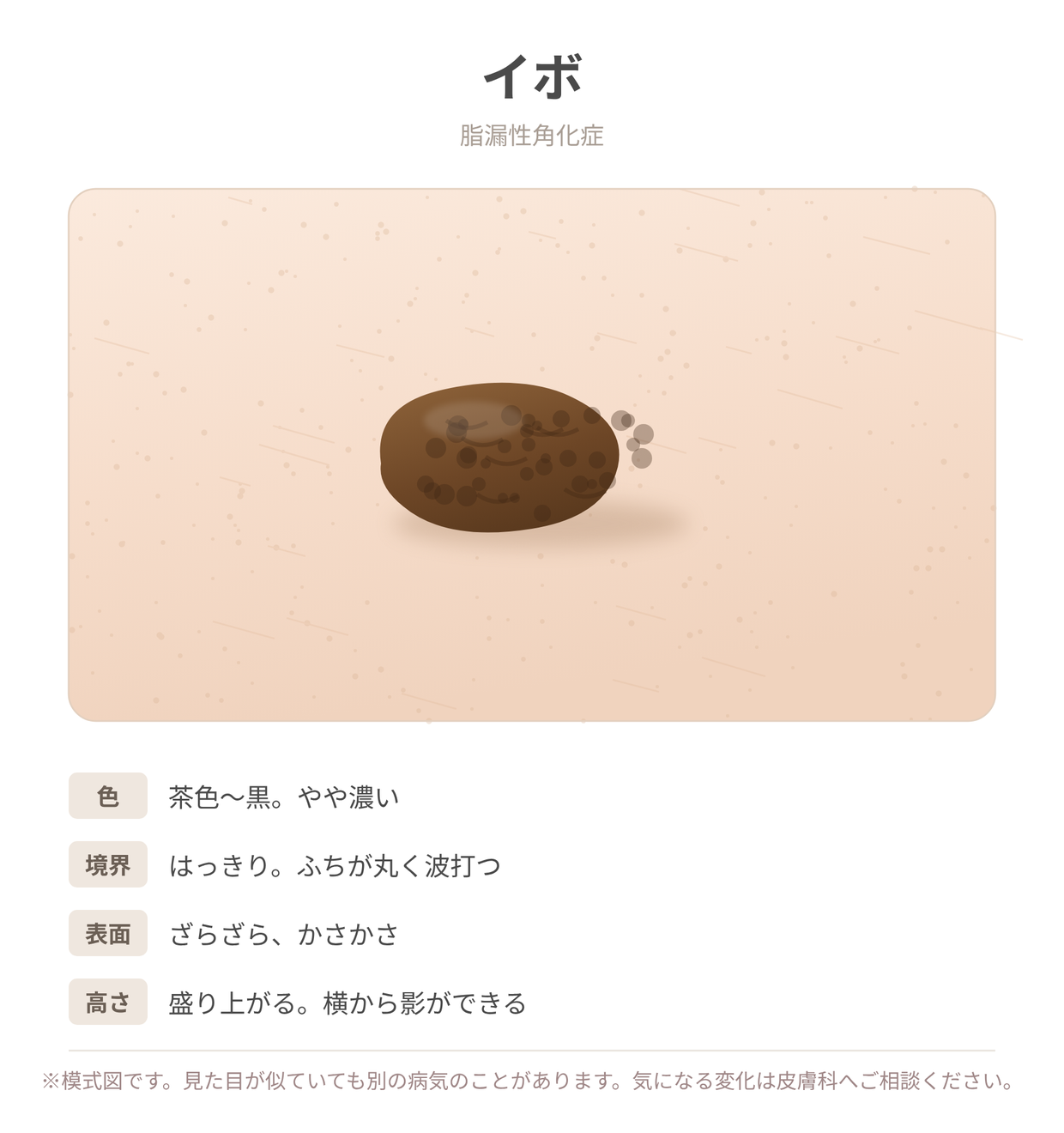 イボ（脂漏性角化症）の見た目と特徴を示した説明用イラスト