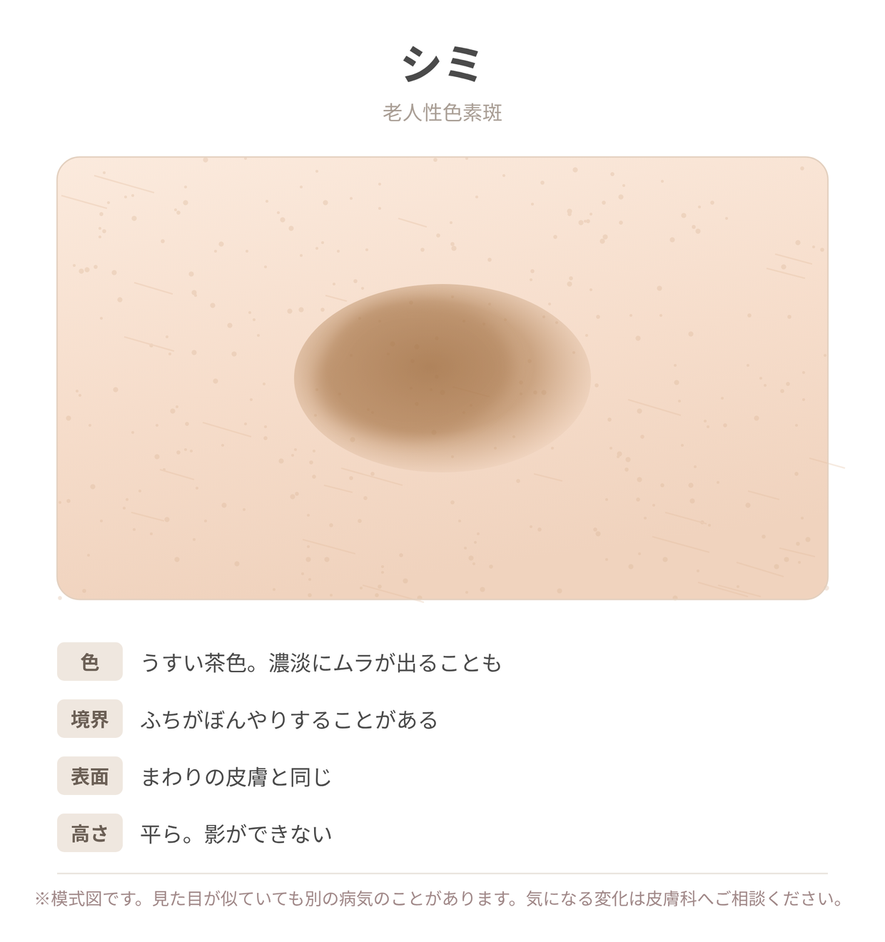 シミ（老人性色素斑）の見た目と特徴を示した説明用イラスト